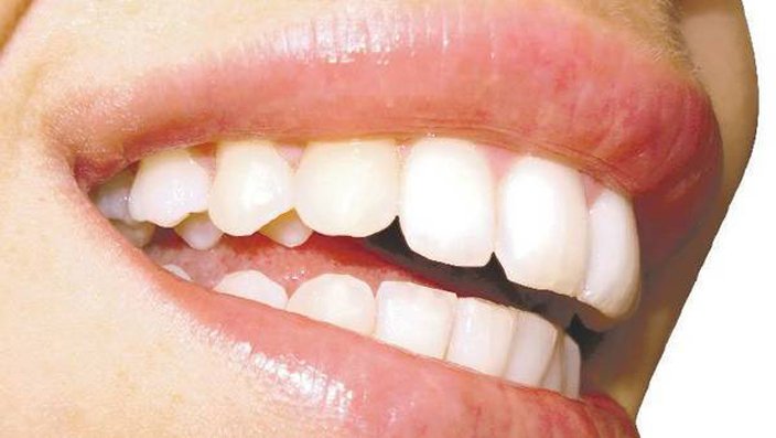 blanco dental Archives - Blog Dental Navarro