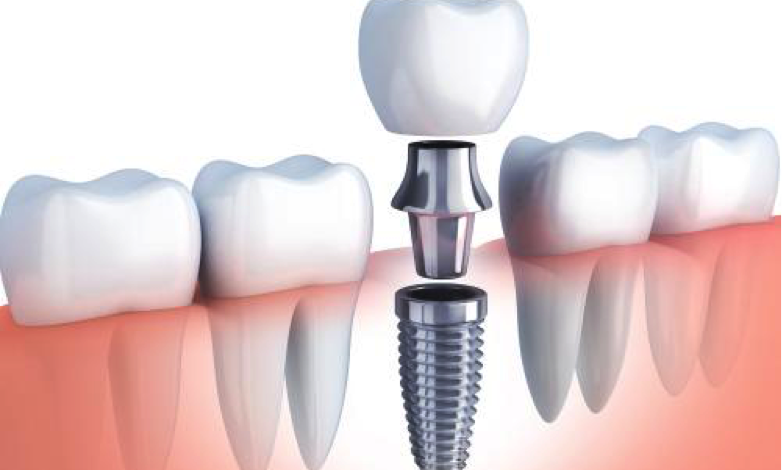 faqs y preguntas frecuentes de los pacientes sobre implantes dentales y su proceso de colocación