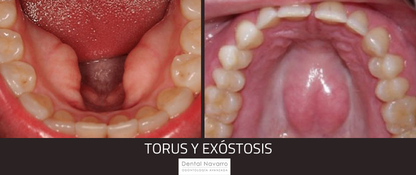 torus y exóstosis que son y si necesitan tratamiento