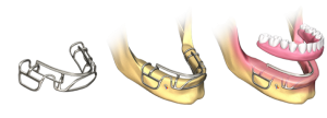 implantes dentales subperiósticos